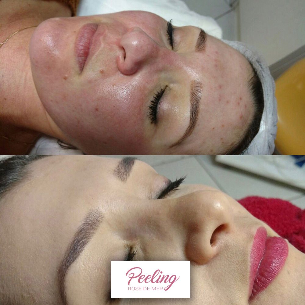 Antes E Depois 3